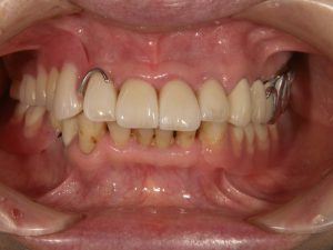 PAアタッチメントの義歯を装着する前の症例写真
