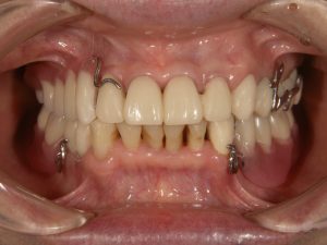 治療用の仮歯と入れ歯を装着した症例写真
