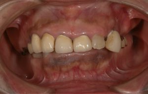 コーヌスクローネ義歯（入れ歯）の治療前の症例写真