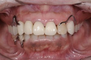 治療用入れ歯の装着した症例写真