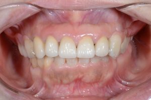 コーヌスクローネ義歯を装着した治療後の症例写真