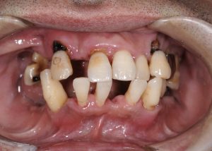 歯周病になり、歯が傾いて、かみ合わせもズレていたことがわかる症例写真