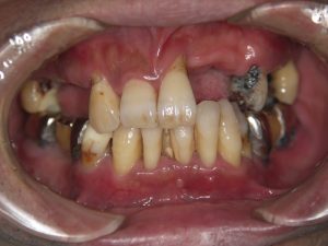 歯周病になり、歯が傾いて、かみ合わせもズレていることがわかる症例写真