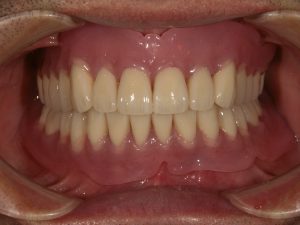 特殊プラスチック義歯による総義歯の症例｜デンタルオフィスハル（大阪 