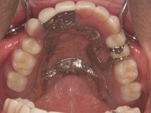 インプラントと歯の根っこを入れ歯の安定に使用した症例写真1