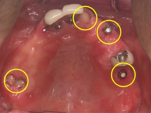 インプラントと歯の根っこを入れ歯の安定に使用した症例写真2