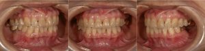 治療前「奥歯がなく差し歯が何回も取れて入れ歯で噛めない」